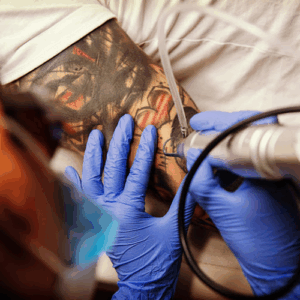 Blank Tattooentfernung
