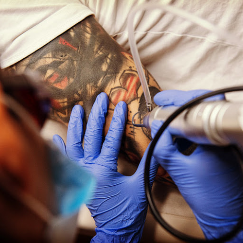 Blank Tattooentfernung